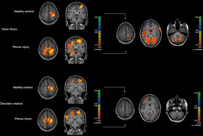 Cerebral Reorganization in Patients with Brachial Plexus Birth Injury and Residual Shoulder Problems